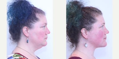 Neck Lift before and after photo