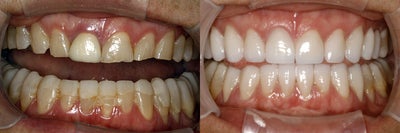 Smile Makeover before and after photo