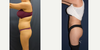Brazilian Butt Lift before and after photo