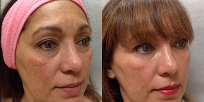 Dermal Fillers before and after photo
