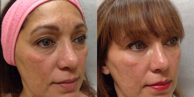 Dermal Fillers before and after photo