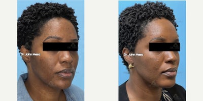FaceTite before and after photo