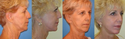 Laser Resurfacing before and after photo