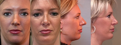 Rhinoplasty before and after photo