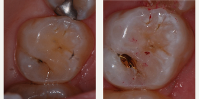 Tooth Repair before and after photo
