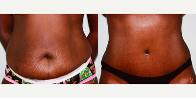 Tummy Tuck before and after photo