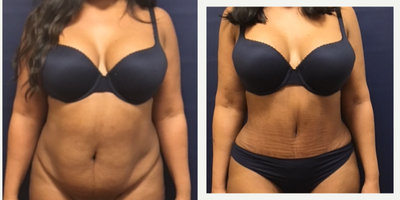 Tummy Tuck before and after photo