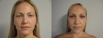 Brow Lift before and after photo