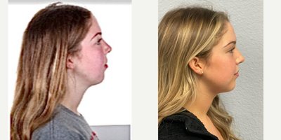 Jaw Surgery before and after photo