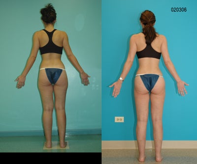 Liposculpture before and after photo