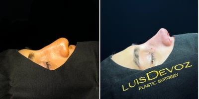 Rhinoplasty before and after photo