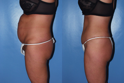 Tummy Tuck before and after photo