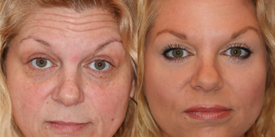 Botox before and after photo