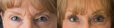 Brow Lift before and after photo