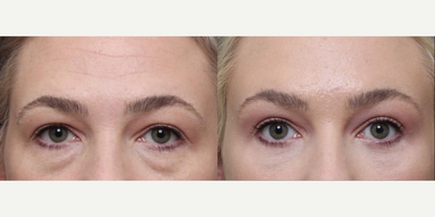 Brow Lift before and after photo