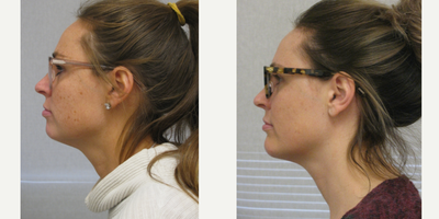 Chin Implant before and after photo