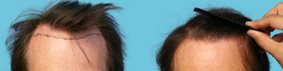 FUE Hair Transplant before and after photo