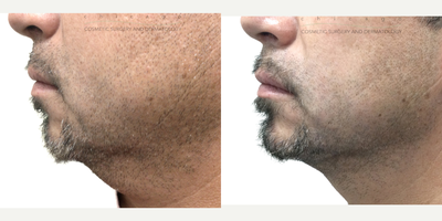 Kybella before and after photo