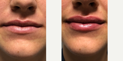 Lip Fillers before and after photo
