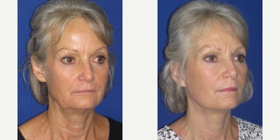 Mini Facelift before and after photo