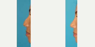 Rhinoplasty before and after photo