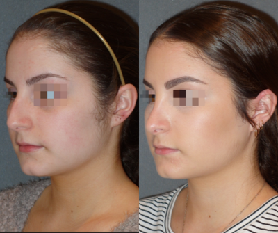 Rhinoplasty before and after photo