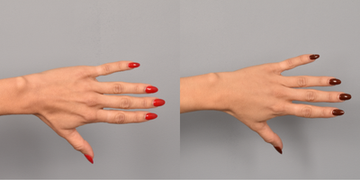 Dermal Fillers before and after photo