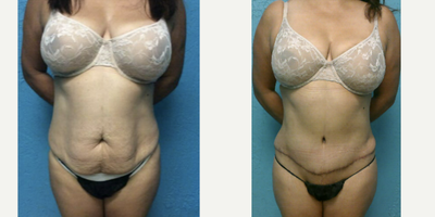 Drainless Tummy Tuck before and after photo