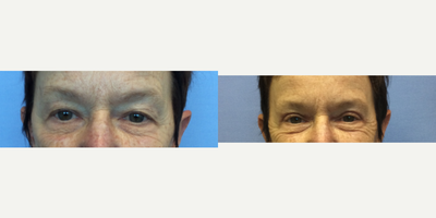 Eyelid Surgery before and after photo
