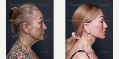 Eyelid Surgery before and after photo