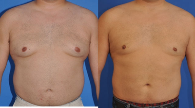 Gynecomastia Surgery before and after photo