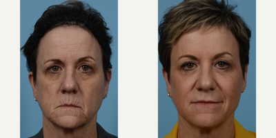 Juvederm before and after photo