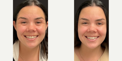 Botox before and after photo