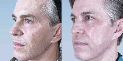 CO2 Laser before and after photo