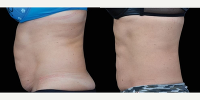 Emsculpt before and after photo