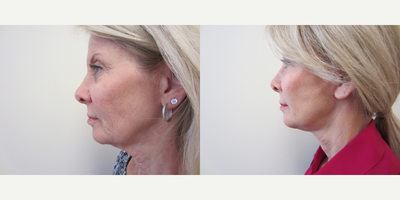 Facelift before and after photo