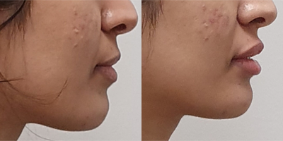Lip Fillers before and after photo