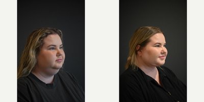 Neck Lift before and after photo