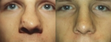 Rhinoplasty before and after photo