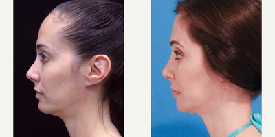 Rhinoplasty before and after photo