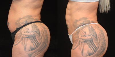 Abdominal Etching before and after photo