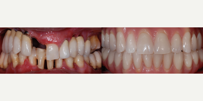 All-on-4 Dental Implants before and after photo