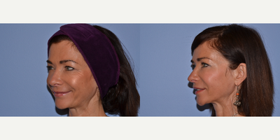 Botox before and after photo