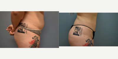 Liposuction before and after photo