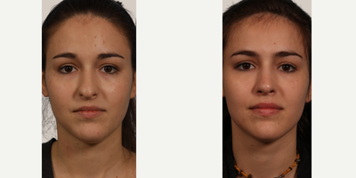 Rhinoplasty before and after photo