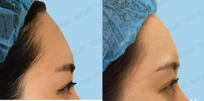 Bellafill before and after photo