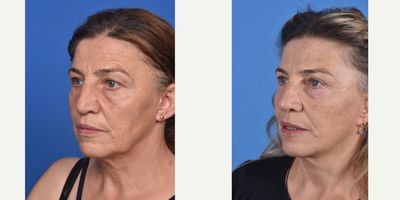 Facelift before and after photo