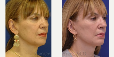 Facelift before and after photo