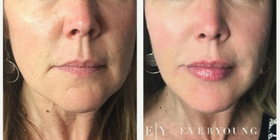 Lip Fillers before and after photo