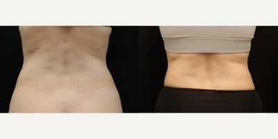 Liposuction before and after photo